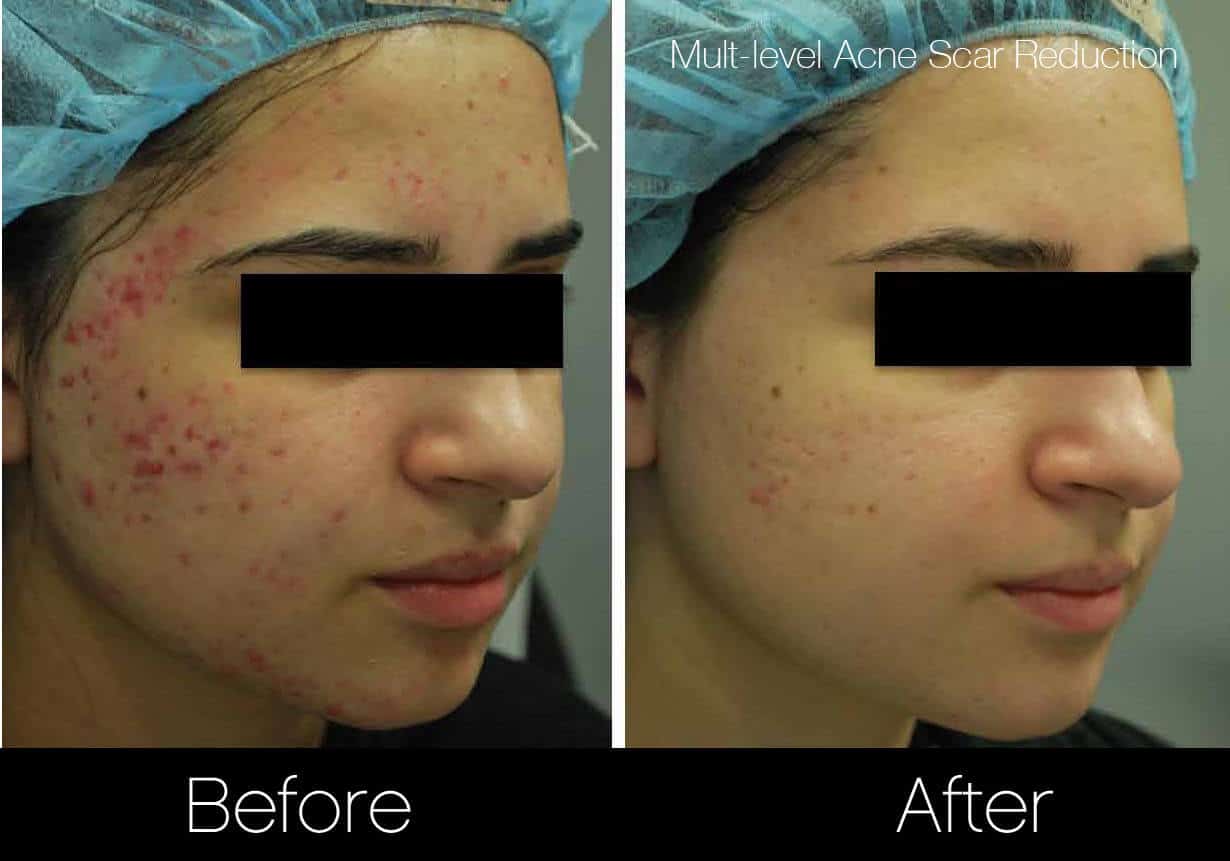 Acne And Acne Scars Treatment