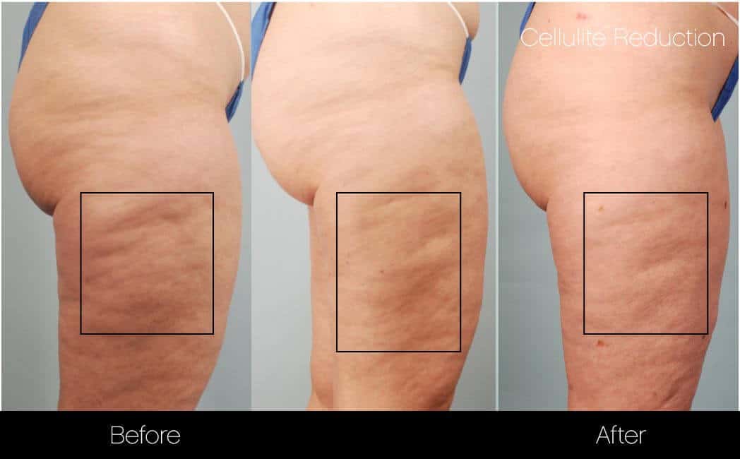 Cellulite Reduction Treatment in Toronto