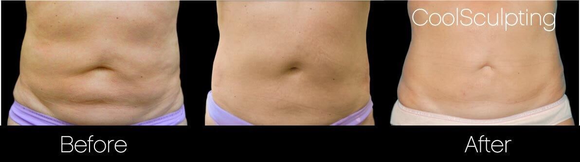 CoolSculpting®  Non-Invasive Way to Reduce Fat and Contour Your Body