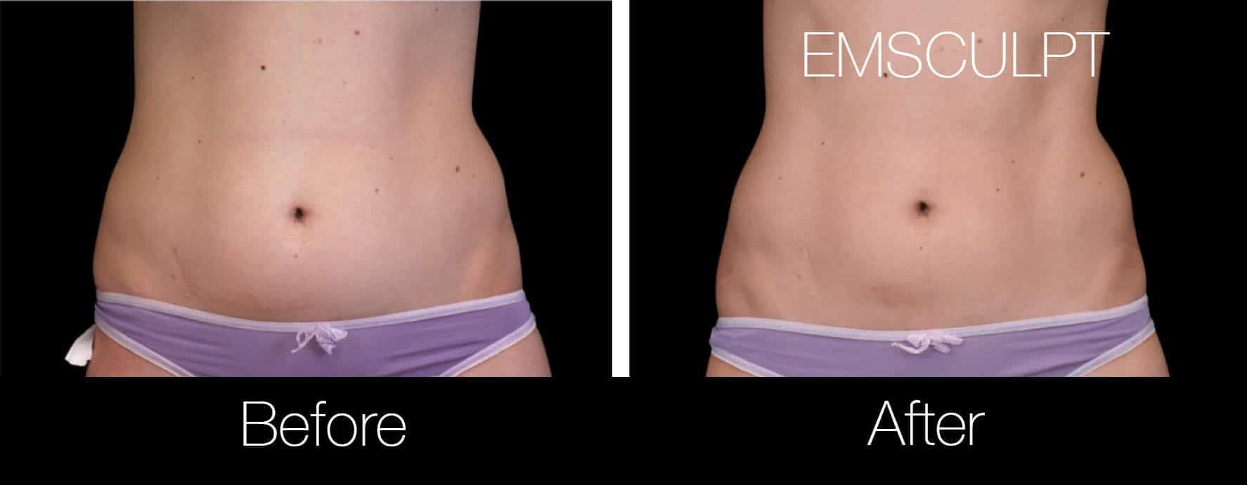 EmSculpt for Mommy Tummy - Cosmetic Dermatology Center
