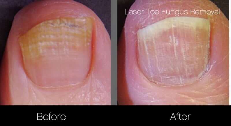 Home - Nail Fungus Expert in Melbourne | Astonishing results
