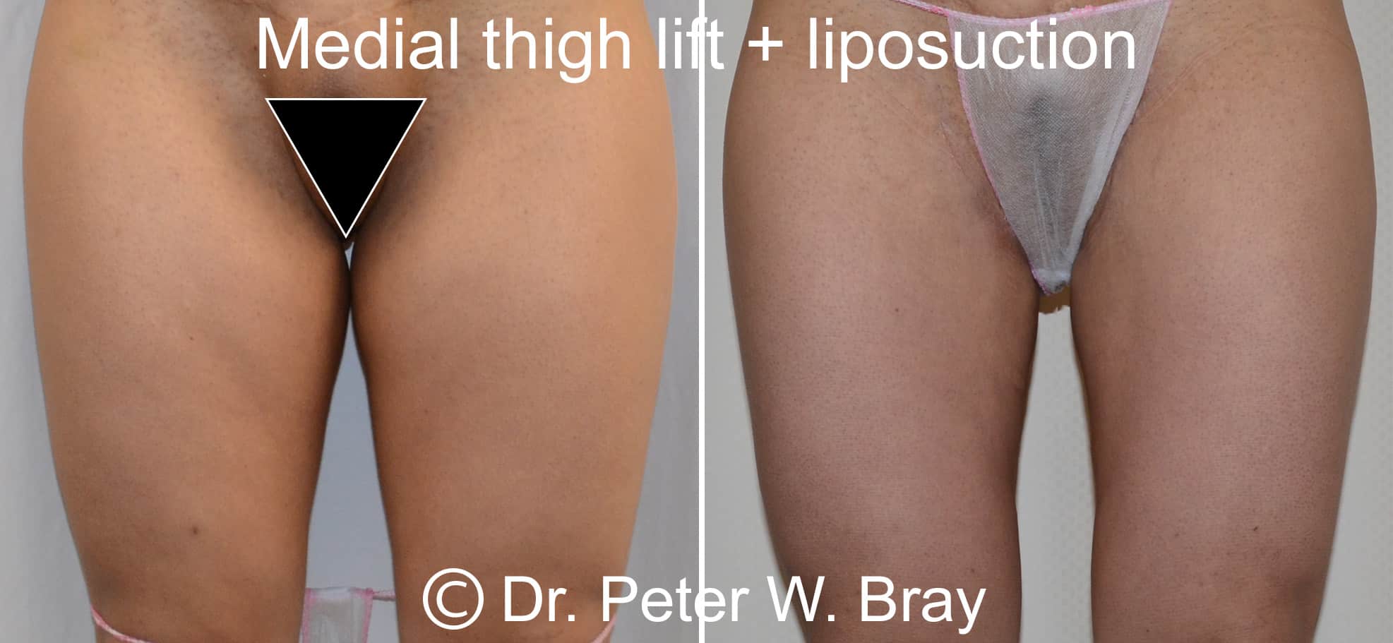 🥇 NYC Thigh Lift (Thighplasty)  Manhattan Thigh Plastic Surgery