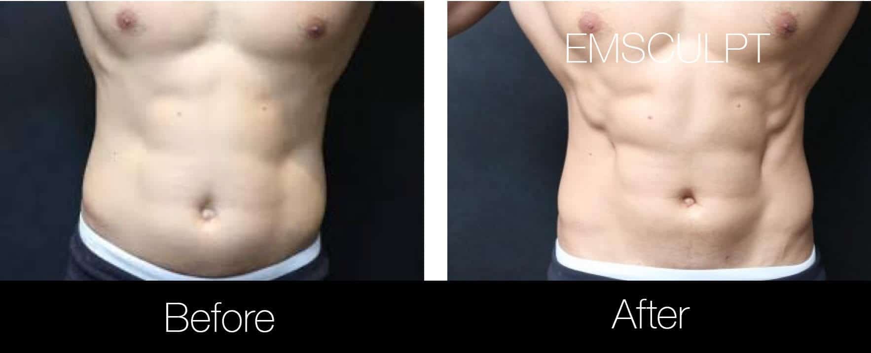 EMsculpt Treatment in Toronto - See Our Before & Afters!