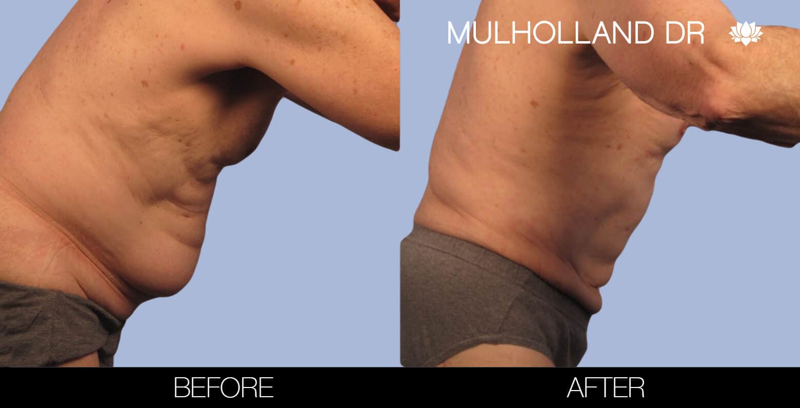 Male Tummy Tuck - Before and After Photos
