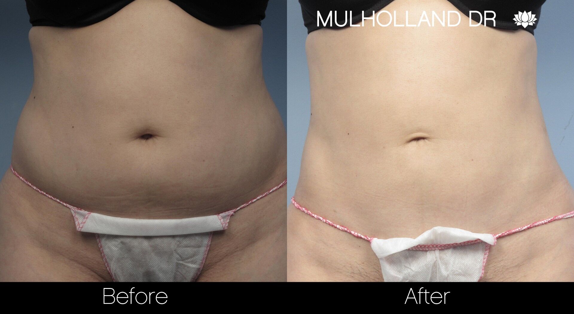 Liposuction in Nova Scotia: Sculpt Your Dream Body with Our Trusted Surgeons