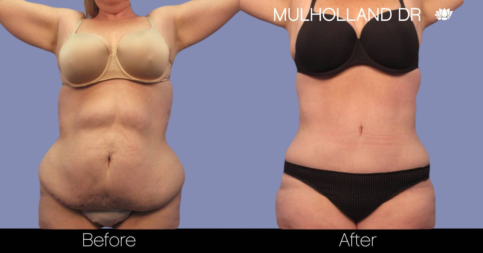 Toronto Liposuction Clinic - See Costs & Before/Afters!