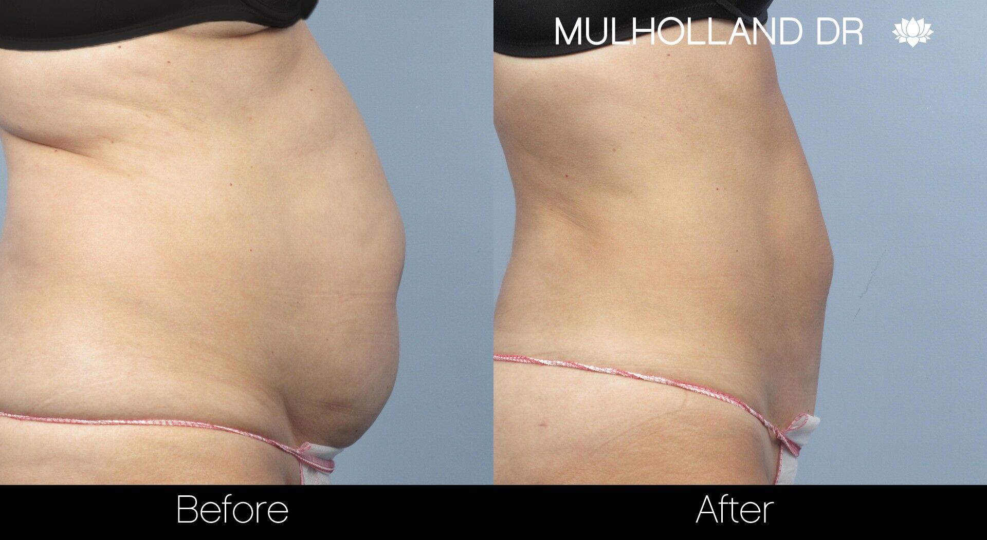 3 Areas To Do Liposuction On To Completely Transform Your Body