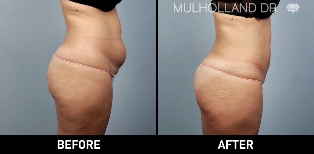 BodyTite Liposuction in Toronto