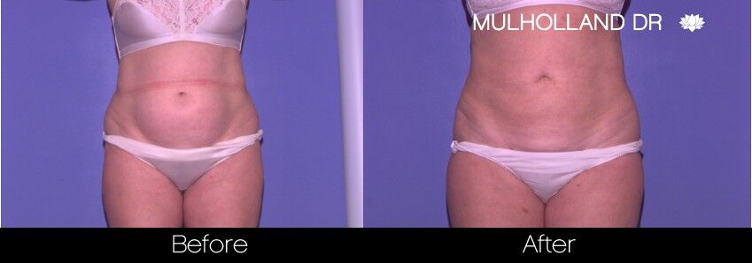 43 F After Tummy Tuck with Lipo 360