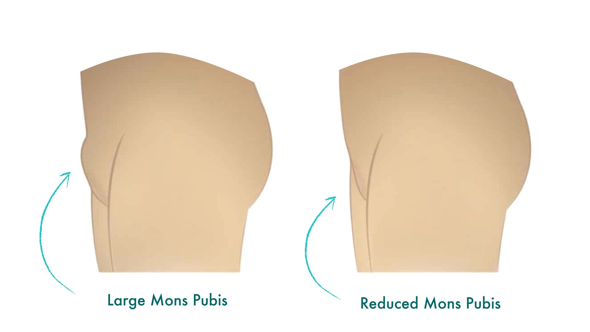 Liposuction (PAL) with Mons pubis GA-(BWMC)