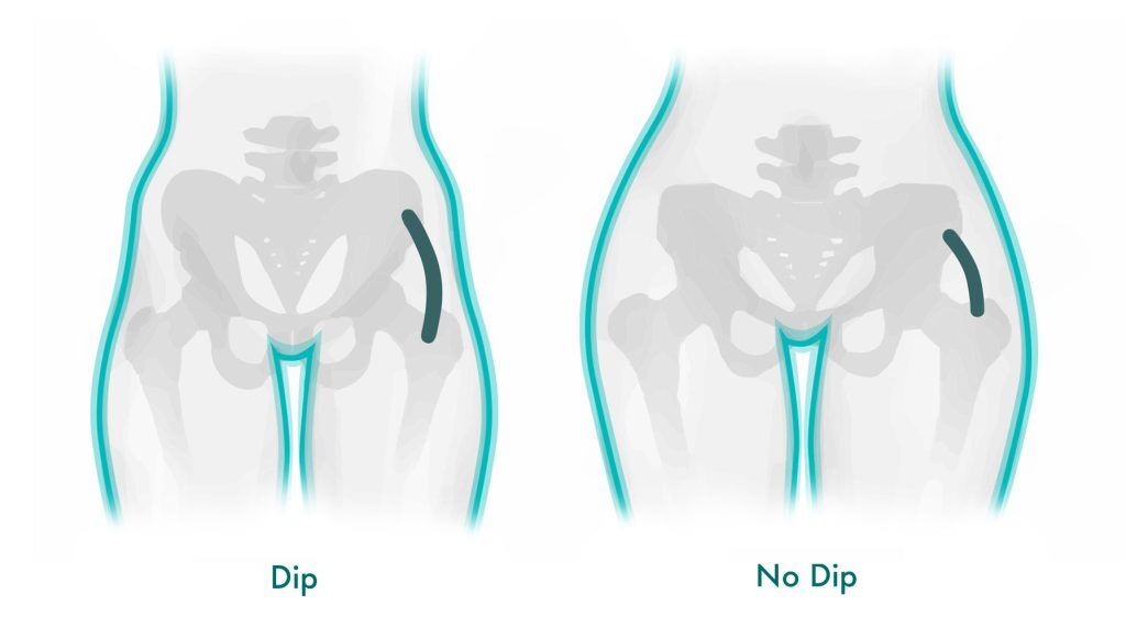 What Causes Hip Dips and How to Get Rid of Them